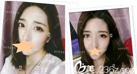 <!--<i data=20240703-sp></i>-->整形雙眼皮手術加開眼角手術案例