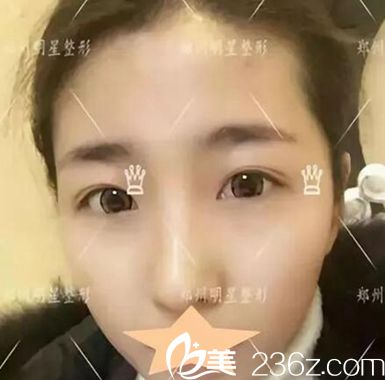 <!--<i data=20240703-sp></i>-->整形雙眼皮顧客術前