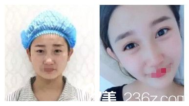 邢臺(tái)博愛(ài)雙眼皮案例