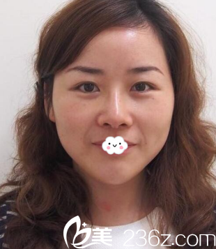 開(kāi)心！東營(yíng)藝美李琳膨體隆鼻綜合整形將我朝天鼻矯正修復(fù)(20天案例恢復(fù)圖)