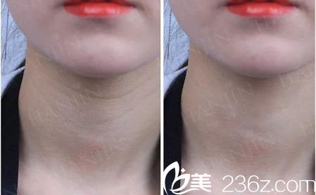 昆明韓辰李杰祛頸紋案例 昆明韓辰李杰祛頸紋案例