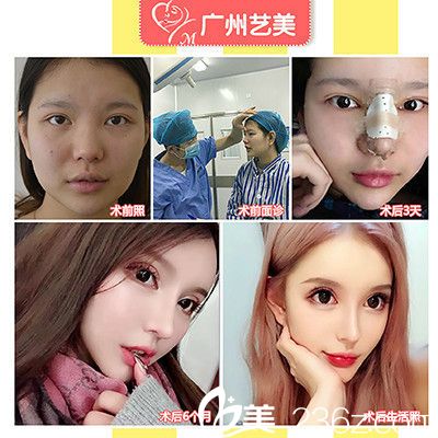 廣州藝美李闖院長做的李氏3C翹鼻術案例 廣州藝美李闖院長做的李氏3C翹鼻術案例