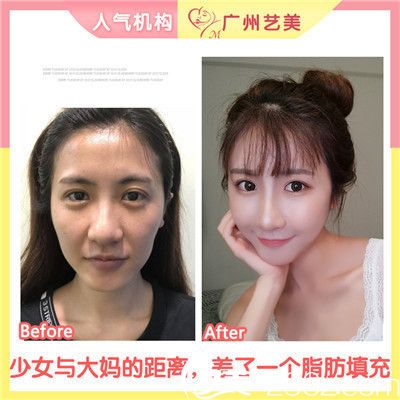 廣州藝美李闖院長做的自體脂肪面部填充案例 廣州藝美李闖院長做的自體脂肪面部填充案例