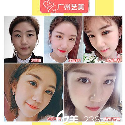 廣州藝美張濤院長做的切開雙眼皮案例 廣州藝美張濤院長做的切開雙眼皮案例