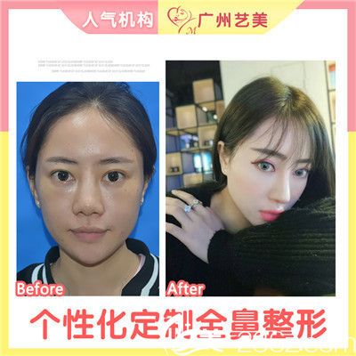 廣州藝美李闖院長做的肋軟骨隆鼻失敗修復案例 廣州藝美李闖院長做的肋軟骨隆鼻失敗修復案例