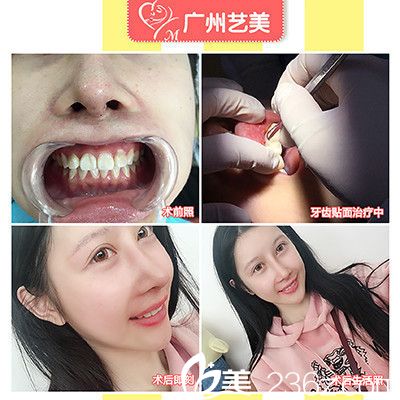 廣州藝美袁媛做的牙貼面真人案例 廣州藝美袁媛做的牙貼面真人案例
