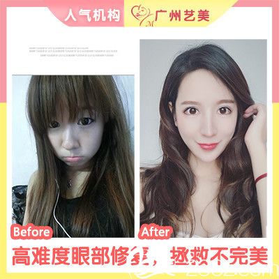 廣州藝美張濤院長做的雙眼皮失敗修復案例 廣州藝美張濤院長做的雙眼皮失敗修復案例