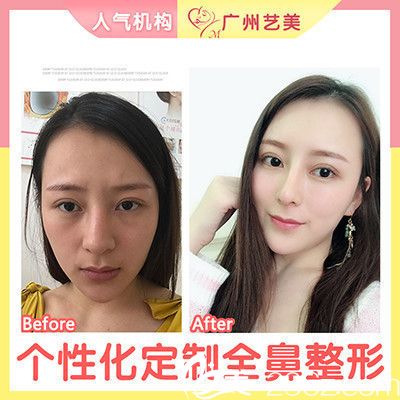廣州藝美李闖做的肋軟骨隆鼻案例 廣州藝美李闖做的肋軟骨隆鼻案例