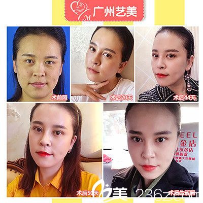 廣州藝美張濤院長面部<span style= 廣州藝美張濤院長面部<span style=