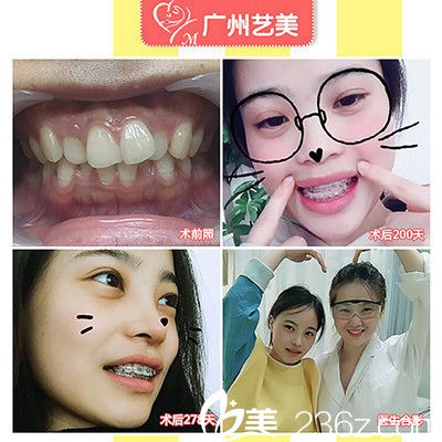 廣州藝美袁媛主任做的牙齒矯正案例 廣州藝美袁媛主任做的牙齒矯正案例