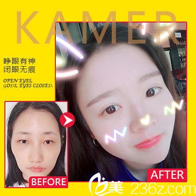 廣州可玫爾整形醫(yī)院<!--<i data=20240703-sp></i>-->誠做的雙眼皮和脂肪填充 廣州可玫爾整形醫(yī)院<!--<i data=20240703-sp></i>-->誠做的雙眼皮和脂肪填充