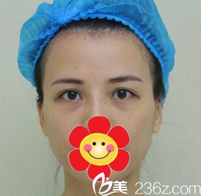 呼和浩特紫潔整形去眼袋前 呼和浩特紫潔整形去眼袋前