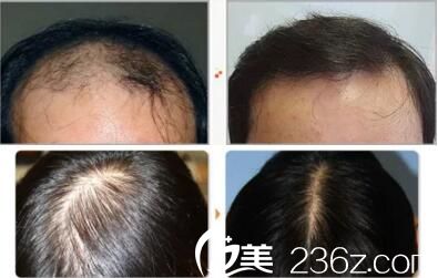 毛發(fā)移植真人案例前后效果對(duì)比