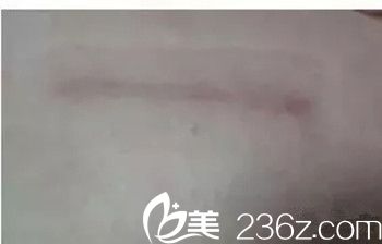 5.webp.jpg 乳房下皺襞切口恢復(fù)情況 5.webp.jpg 乳房下皺襞切口恢復(fù)情況