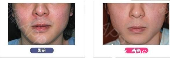 面部輪廓整形削下巴