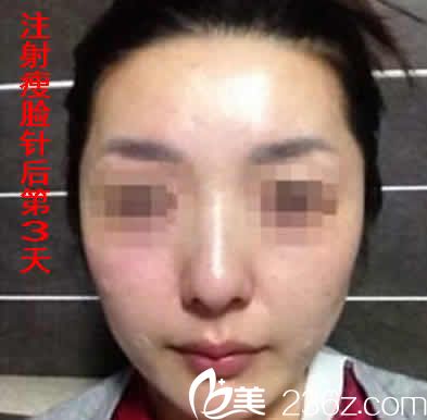 我在運城華美打瘦臉后第3天照片