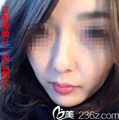 我在運城華美注射瘦臉后一周照片