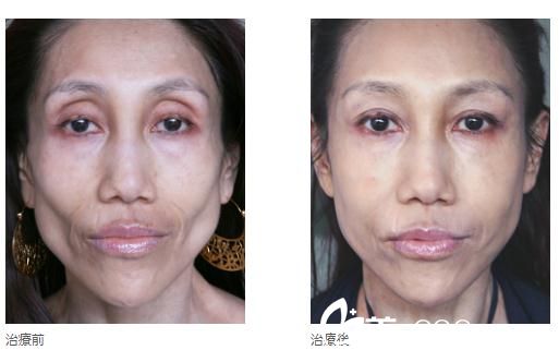 高見式玻尿酸注入