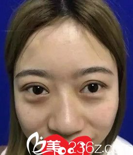 術(shù)前鼻子塌平 術(shù)前鼻子塌平