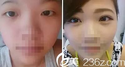 荊門和麗雙眼皮案例