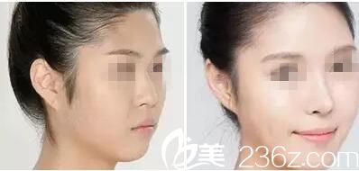 荊門和麗隆鼻案例