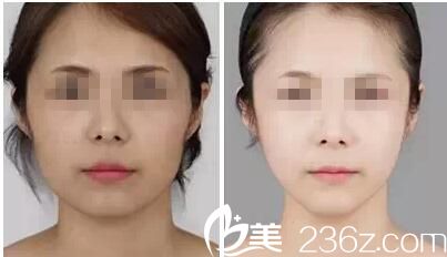 荊門和麗瘦臉案例