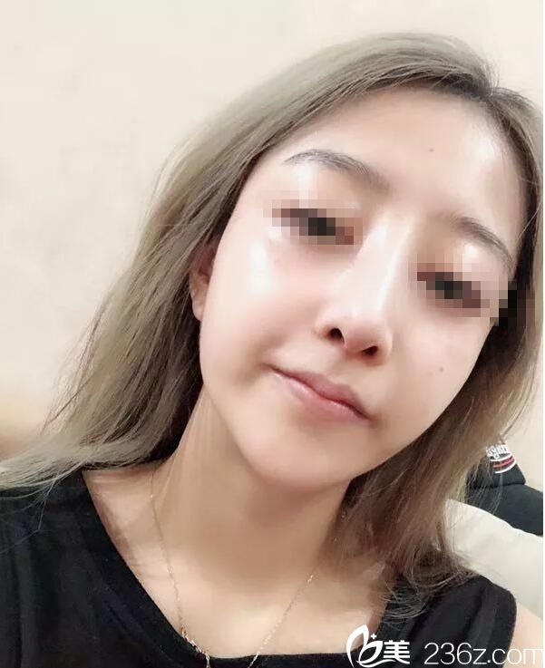 鼻綜合術(shù)后7天拆線效果 鼻綜合術(shù)后7天拆線效果