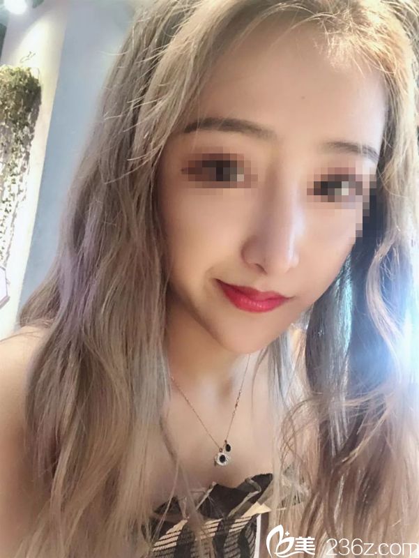 追求網紅鼻的我去荊門和麗做隆鼻手術 醫(yī)生面診后建議我做肋軟骨+耳軟骨縮小鼻頭鼻翼