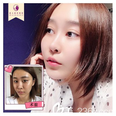 廣州佳人整形醫(yī)院王<!--<i data=20240703-sp></i>-->雙眼皮隆鼻案例 廣州佳人整形醫(yī)院王<!--<i data=20240703-sp></i>-->雙眼皮隆鼻案例