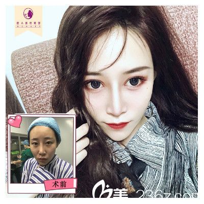 廣州佳人整形醫(yī)院王<!--<i data=20240703-sp></i>-->做的隆鼻案例 廣州佳人整形醫(yī)院王<!--<i data=20240703-sp></i>-->做的隆鼻案例