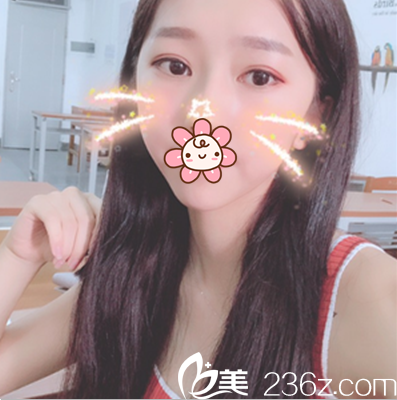 老媽夸我在樂(lè)山達(dá)芬奇做的埋線(xiàn)平行雙眼皮顯得眼睛大好看