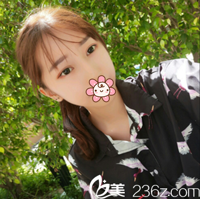 埋線雙眼皮術(shù)后一個(gè)月恢復(fù)效果 埋線雙眼皮術(shù)后一個(gè)月恢復(fù)效果