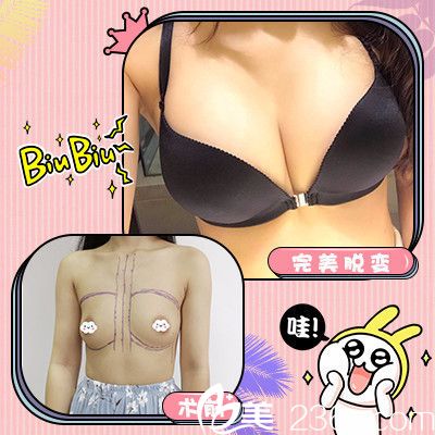 廣州佳人醫(yī)療美容王<!--<i data=20240703-sp></i>-->隆胸案例 廣州佳人醫(yī)療美容王<!--<i data=20240703-sp></i>-->隆胸案例