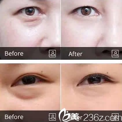太原華美整形呂睿紘無痕祛眼袋前后效果對比圖