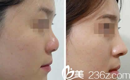 呂睿紘博士韓式4D隆鼻案例效果圖