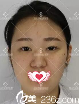 做玻尿酸隆鼻+隆下巴術前照片 做玻尿酸隆鼻+隆下巴術前照片