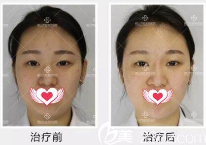 玻尿酸隆鼻+隆下巴術前術后<span style= 玻尿酸隆鼻+隆下巴術前術后<span style=