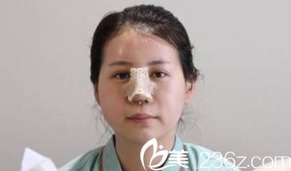 做完科克倫鼻綜合隆鼻3天恢復(fù)照