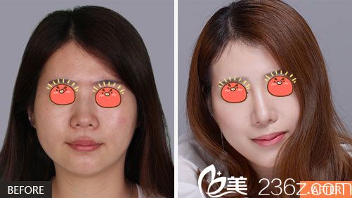 寧波薇琳雷艷莉鼻綜合隆鼻案例