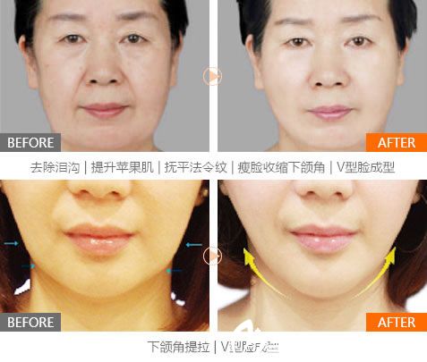 寧波薇琳鄭永強(qiáng)面部線雕案例