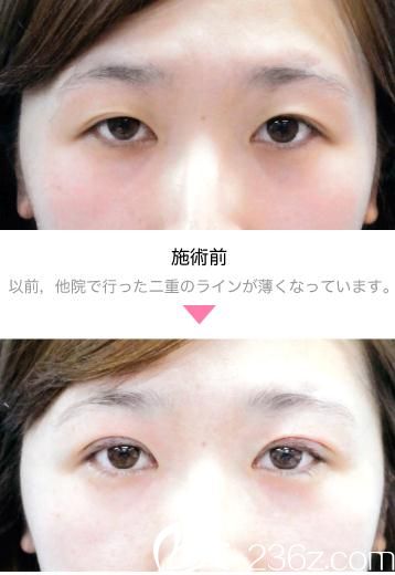 埋線雙眼皮