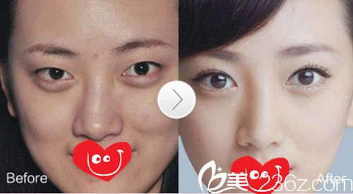 邯鄲京美雙眼皮案例