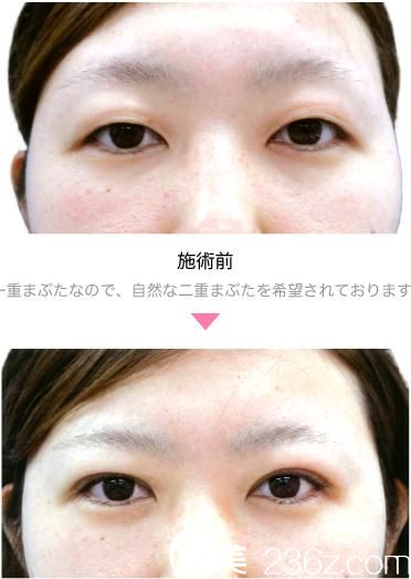 埋線雙眼皮 埋線雙眼皮