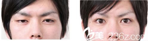 眼瞼下垂修正 眼瞼下垂修正