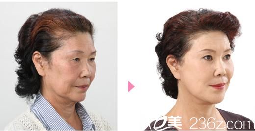 竹內(nèi)式面部拉皮 W-SMAS 竹內(nèi)式面部拉皮 W-SMAS