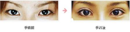 全切雙眼皮