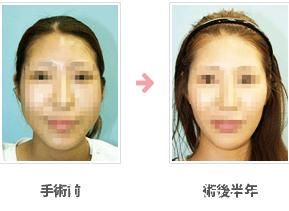 頰骨削.jpg 削頰骨