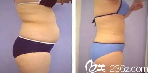 醫(yī)療美容李斌醫(yī)生腰腹吸脂案例