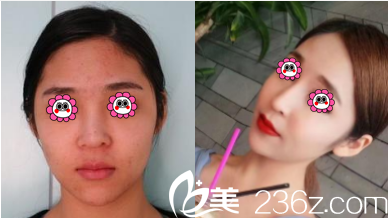 醫(yī)療美容周亞芹耳軟骨隆鼻案例 醫(yī)療美容周亞芹耳軟骨隆鼻案例