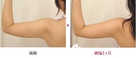 真崎式吸脂手術(shù) 真崎式吸脂手術(shù)